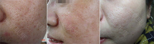 1524812973389867.jpg 痘印.jpg